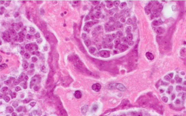 Pequenos tecidos cancerígenos de vermes estavam crescendo no paciente